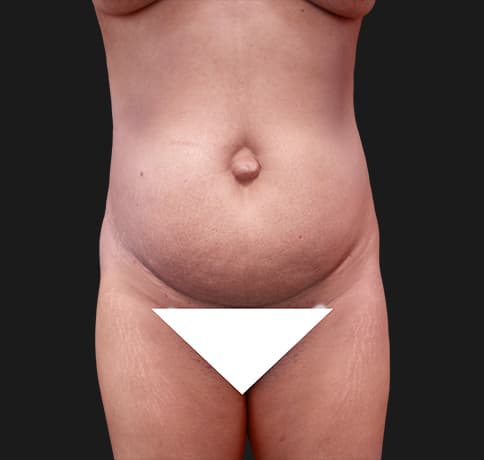 Case 31825, Performed By Dr. Tehrani – Before