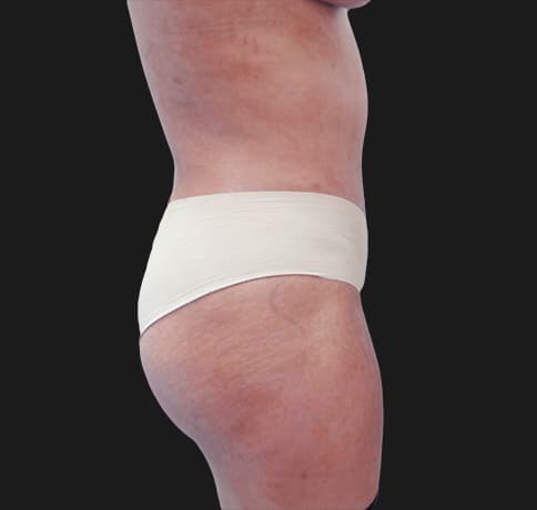 Case 31825, Performed By Dr. Tehrani – angle 2 After