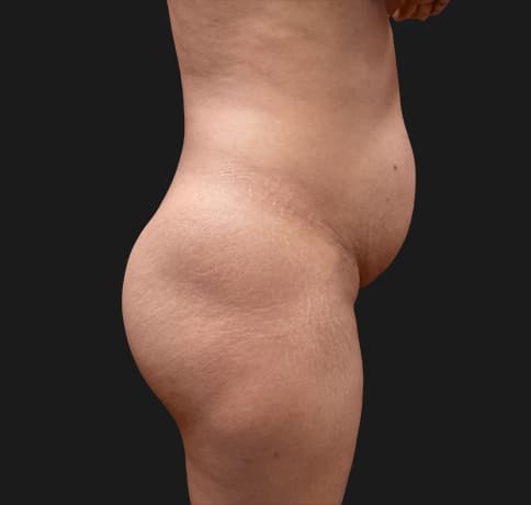 Case 31825, Performed By Dr. Tehrani – angle 2 Before