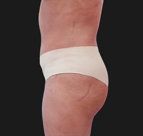 Case 31825, Performed By Dr. Tehrani – angle 3 After