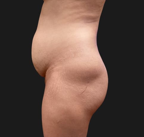 Case 31825, Performed By Dr. Tehrani – angle 3 Before