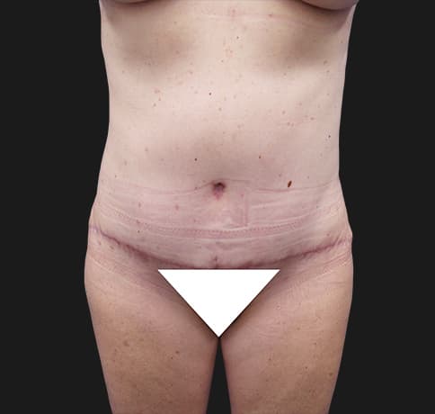 Case 37587, Performed By Dr. Tehrani – After
