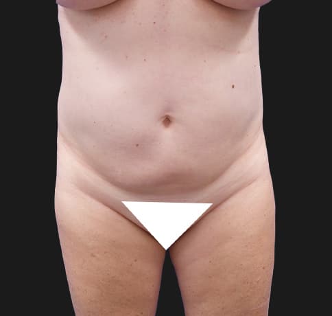 Case 37587, Performed By Dr. Tehrani – Before