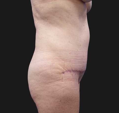 Case 37587, Performed By Dr. Tehrani – angle 2 After