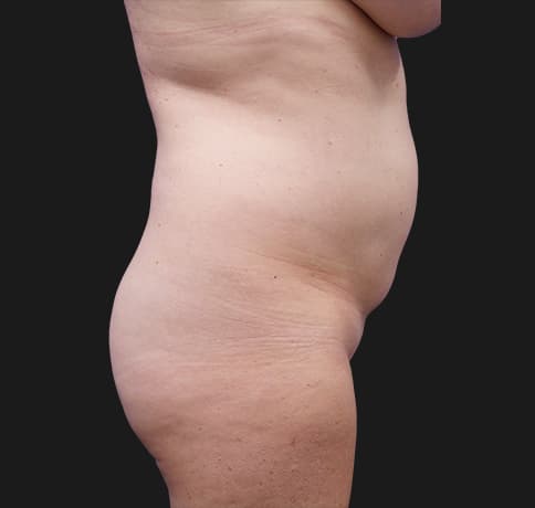 Case 37587, Performed By Dr. Tehrani – angle 2 Before