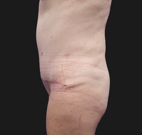 Case 37587, Performed By Dr. Tehrani – angle 3 After