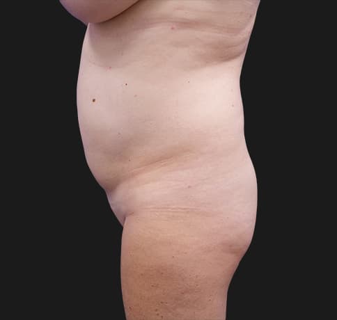 Case 37587, Performed By Dr. Tehrani – angle 3 Before