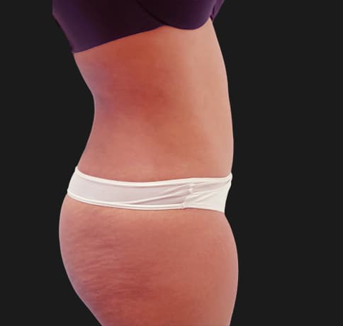 Case 30708, Performed By Dr. Tehrani – angle 2 After