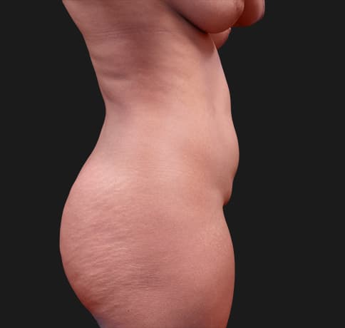 Case 30708, Performed By Dr. Tehrani – angle 2 Before