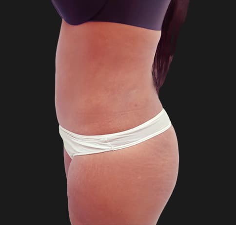 Case 30708, Performed By Dr. Tehrani – angle 3 After