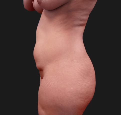 Case 30708, Performed By Dr. Tehrani – angle 3 Before
