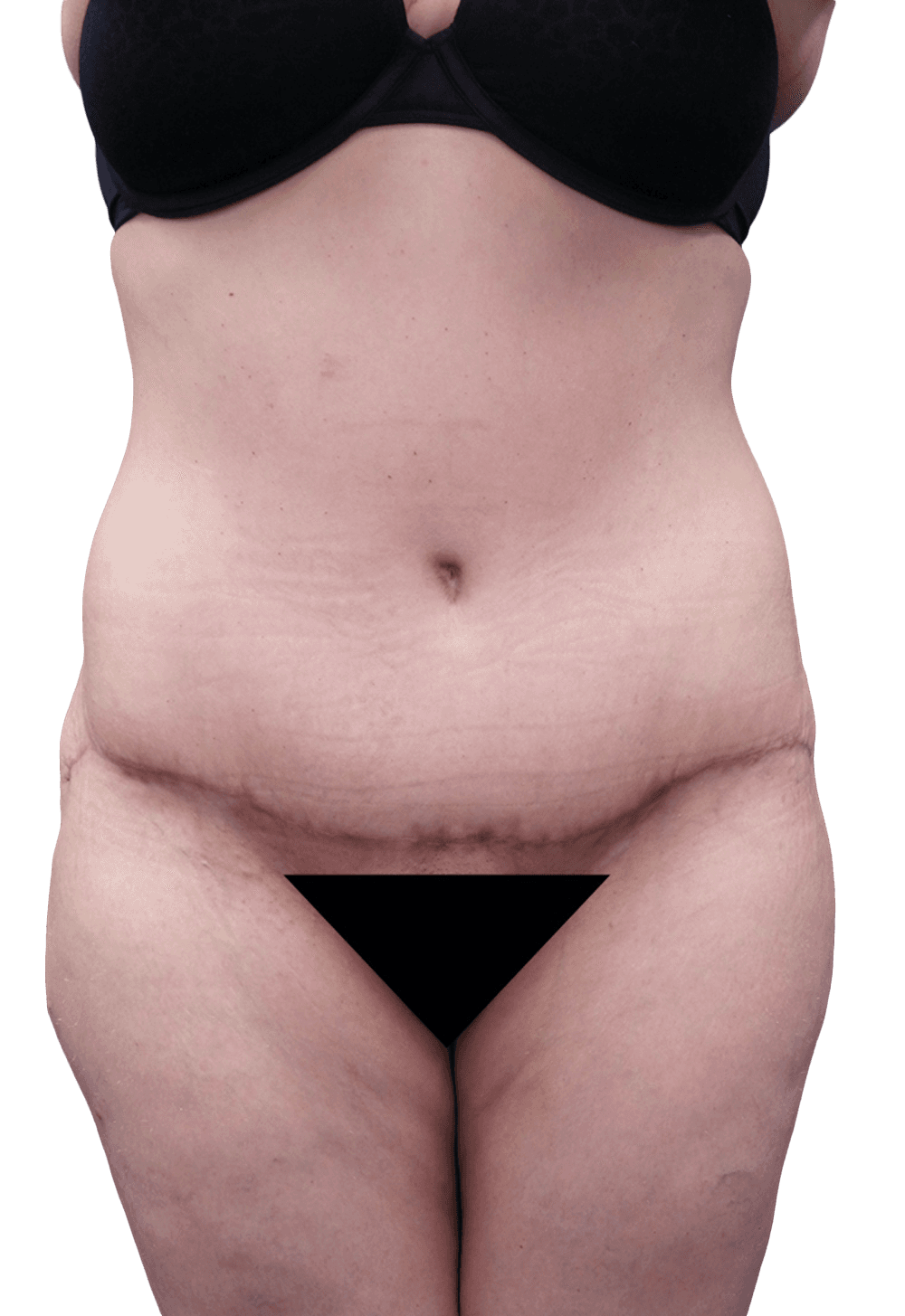 Case 40142, Performed By Dr. Tehrani – After