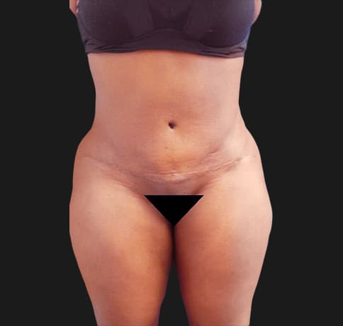 Case 34718, Performed By Dr. Tehrani – After