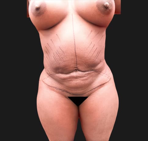 Case 34718, Performed By Dr. Tehrani – Before