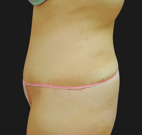 Case 2112, Performed By Dr. Tehrani – angle 3 After