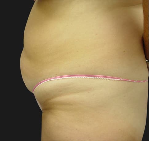 Case 2112, Performed By Dr. Tehrani – angle 3 Before