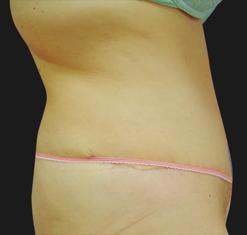 Case 2112, Performed By Dr. Tehrani – angle 2 After