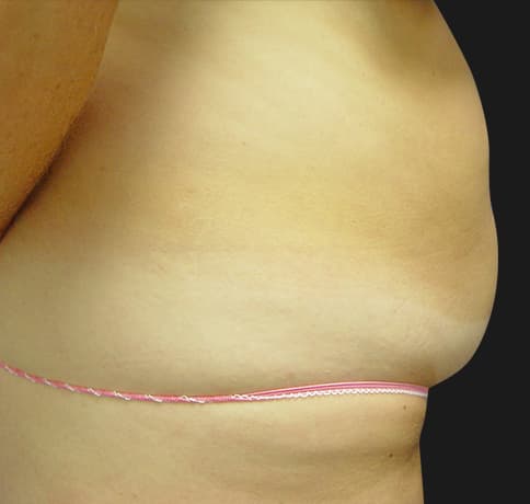 Case 2112, Performed By Dr. Tehrani – angle 2 Before