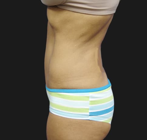 Case 10472, Performed By Dr. Tehrani – angle 3 After