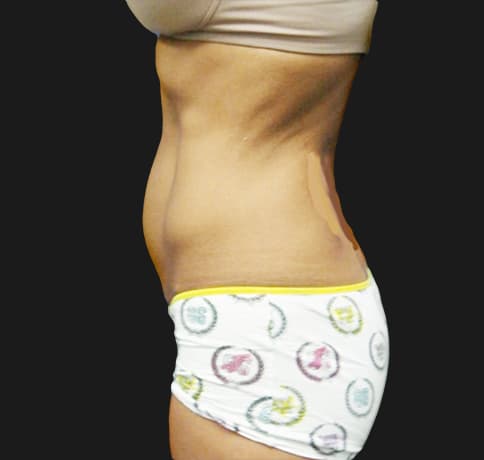 Case 10472, Performed By Dr. Tehrani – angle 3 Before