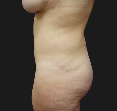 Case 6756 , Performed By Dr. Tehrani – angle 3 After