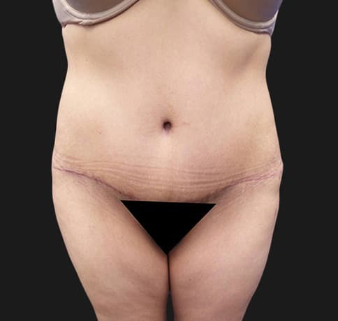 Case 41806, Performed By Dr. Tehrani – After