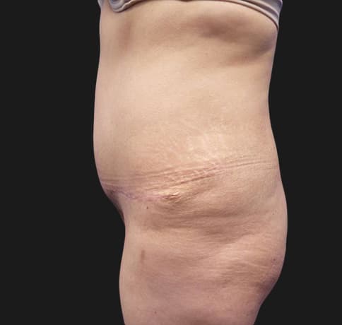 Case 41806, Performed By Dr. Tehrani – angle 3 After