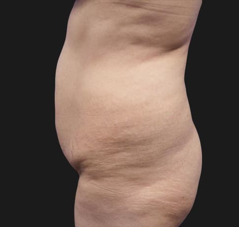 Case 41806, Performed By Dr. Tehrani – angle 3 Before