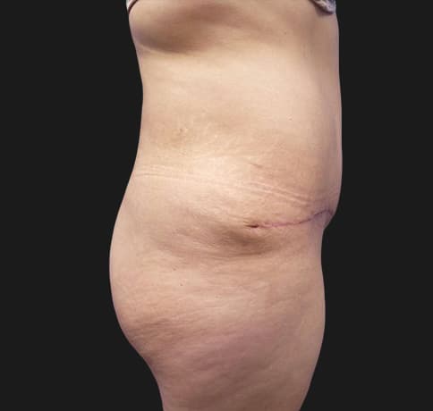Case 41806, Performed By Dr. Tehrani – angle 2 After
