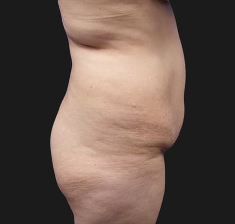 Case 41806, Performed By Dr. Tehrani – angle 2 Before