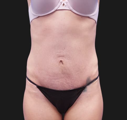 Case 41532, Performed By Dr. Tehrani – After