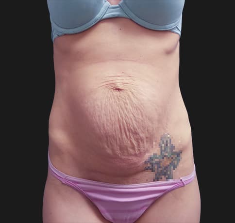 Case 41532, Performed By Dr. Tehrani – Before
