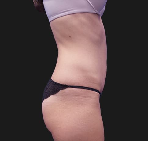 Case 41532, Performed By Dr. Tehrani – angle 2 After