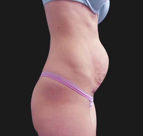 Case 41532, Performed By Dr. Tehrani – angle 2 Before