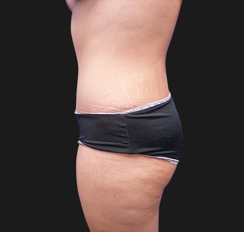 Case 41819, Performed By Dr. Tehrani – angle 3 After