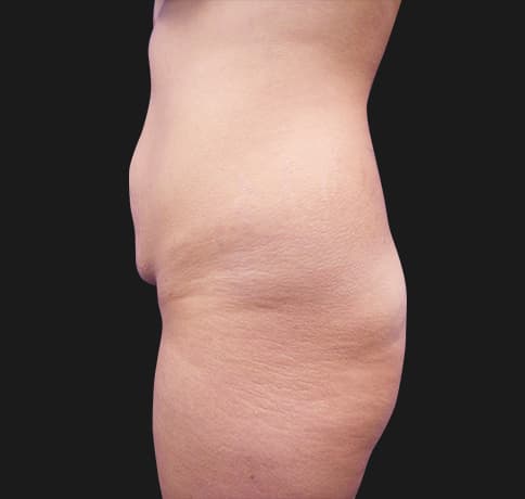 Case 41819, Performed By Dr. Tehrani – angle 3 Before