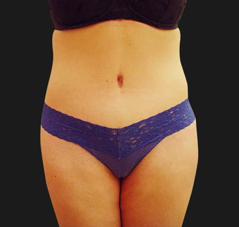 Case 7467, Performed By Dr. Tehrani – After