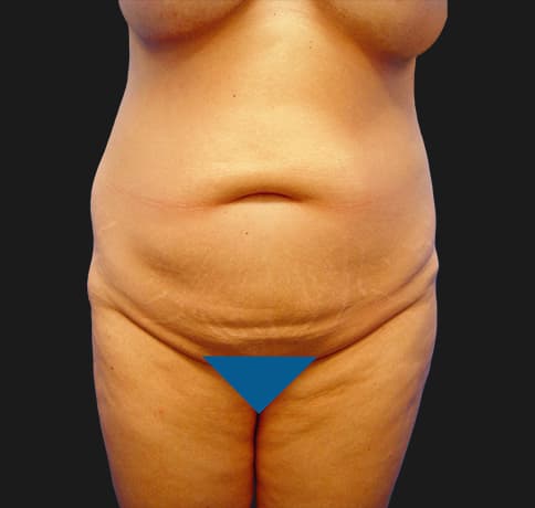 Case 7467, Performed By Dr. Tehrani – Before