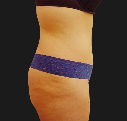 Case 7467, Performed By Dr. Tehrani – angle 2 After