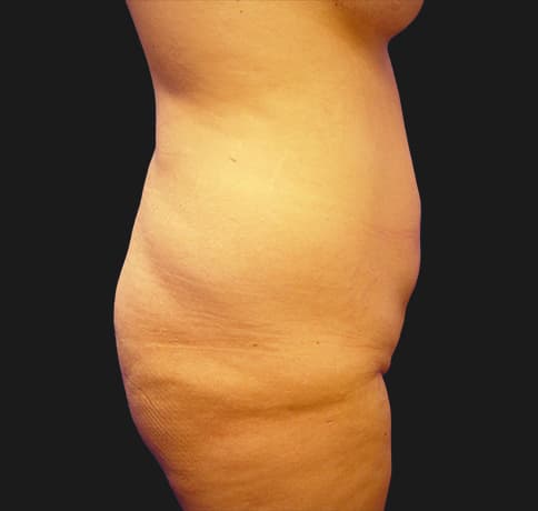 Case 7467, Performed By Dr. Tehrani – angle 2 Before