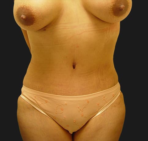 Case 7487, Performed By Dr. Tehrani – After