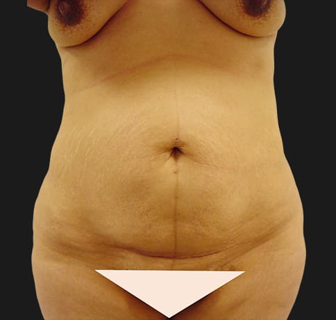 Case 7487, Performed By Dr. Tehrani – Before