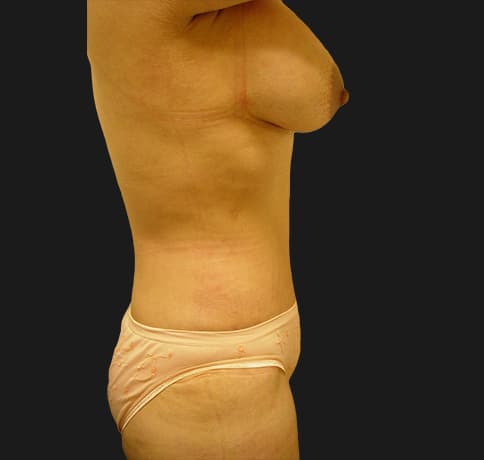 Case 7487, Performed By Dr. Tehrani – angle 2 After