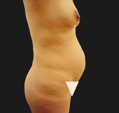 Case 7487, Performed By Dr. Tehrani – angle 2 Before