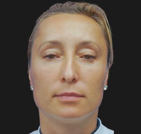 Case 12037 , Performed By Dr. Tehrani – After