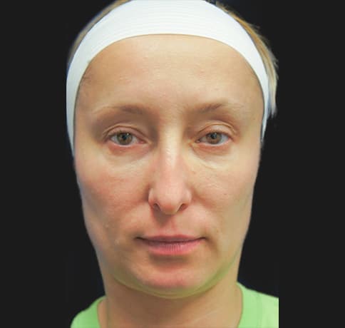 Case 12037 , Performed By Dr. Tehrani – Before