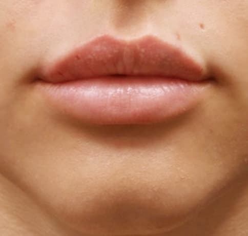 Case 39283, Performed By Dr. Tehrani – After