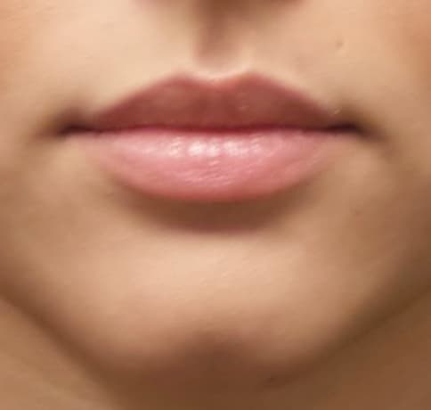 Case 39283, Performed By Dr. Tehrani – Before