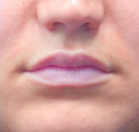 Case 42432, Performed By Dr. Tehrani – Before