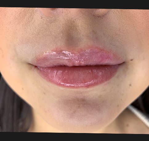 Case 46669, Performed By Dr. Tehrani – After